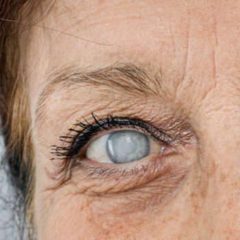 Can Cataracts Come Back? (And Other FAQs)